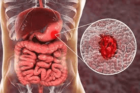 Đau dạ dày là gì? Cách phòng ngừa và điều trị tận gốc? 22 xuat-huyet-tieu-hoa