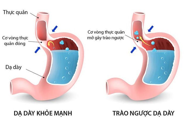trao-nguoc-da-day